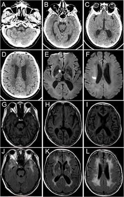 A heterozygous mutation in NOTCH3 in a Chinese family with CADASIL